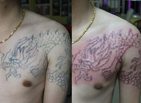 怎么去纹身，去纹身的方法
