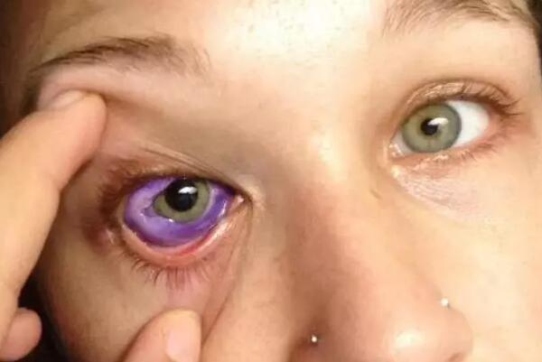 眼球纹身失败案例，是否值得为美丽付出代价